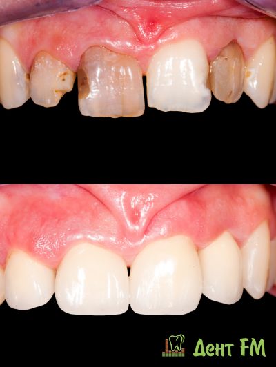 восстановление зубов реставрацией