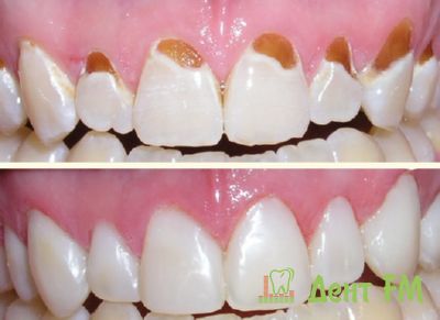 восстановление зубов с клиновидными дефектами