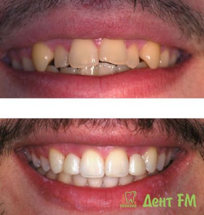 выравнивание зубного ряда с применением реставрационных технологий