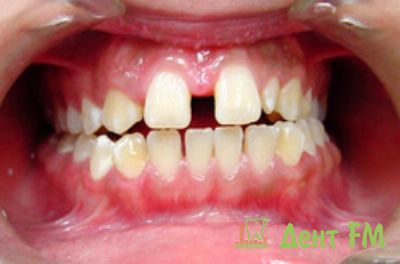 Ортодонтические аномалии