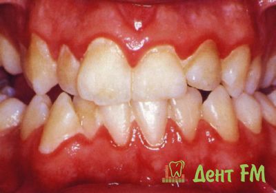 Внешний вид зубных рядов при гингивите