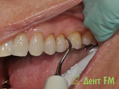 ультразвуковая чистка зубов - комфортная и эффективная процедура