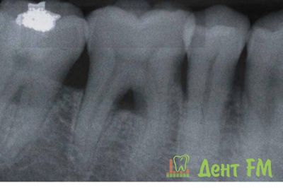 утрата альвеолярной кости - причина подвижности зубов при пародонтите