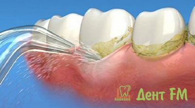 использование ирригатора позволяет избавиться от зубного налета в пришеечной области и улучшить кровоснабжение десны