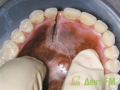 Поломка зубного протеза