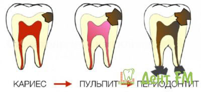 Развитие болезни зуба