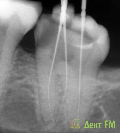 Лечение скрытой части зуба