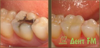 Результат лечения зубных каналов